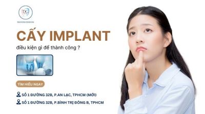 ĐIỀU KIỆN NÀO ĐỂ CẤY GHÉP IMPLANT THÀNH CÔNG?