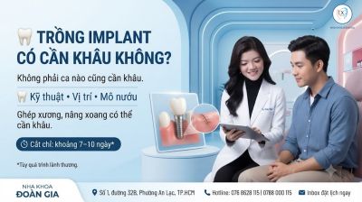 Trồng Implant C&oacute; Cần Kh&acirc;u Kh&ocirc;ng? Bao L&acirc;u Cắt Chỉ?