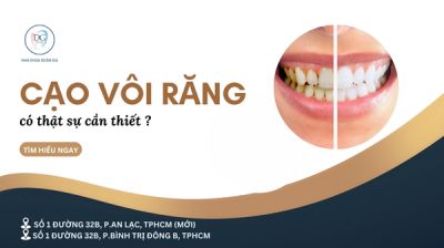 CẠO VÔI RĂNG CÓ THỰC SỰ CẦN THIẾT? BAO LÂU NÊN ĐI MỘT LẦN?