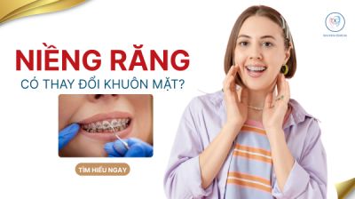 NIỀNG RĂNG THAY ĐỔI GƯƠNG MẶT NHƯ THẾ N&Agrave;O - SỰ THẬT NHIỀU NGƯỜI BẤT NGỜ