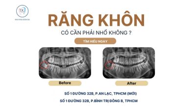 CÓ PHẢI RĂNG KHÔN LÚC NÀO CŨNG PHẢI NHỔ KHÔNG?