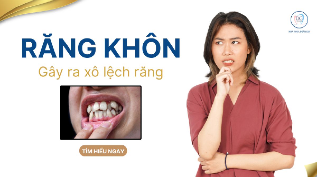RĂNG KH&Ocirc;N L&Agrave;M LỆCH RĂNG ?