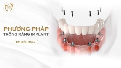 Phương pháp trồng răng Implant là gì? Những lợi ích khi trồng răng Implant