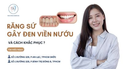 VÌ SAO RĂNG SỨ KIM LOẠI GÂY ĐEN VIỀN NƯỚU VÀ CÁCH KHẮC PHỤC?