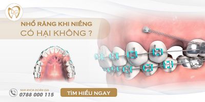 Nhổ răng khi niềng có hại không?