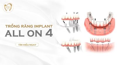 Trồng răng Implant All On 4 có ưu điểm, nhược điểm gì?