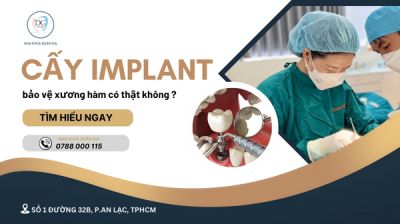 VÌ SAO CẤY IMPLANT GIÚP BẢO VỆ XƯƠNG HÀM?