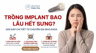 Trồng Implant Bao L&acirc;u Hết Sưng? Giải Đ&aacute;p Chi Tiết Từ Chuy&ecirc;n Gia Nha Khoa