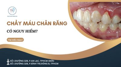 CHẢY MÁU CHÂN RĂNG KHI ĐÁNH RĂNG – CÓ NGUY HIỂM KHÔNG?