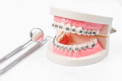 Niềng răng có phải nhổ răng không và phải nhổ bao nhiêu răng?