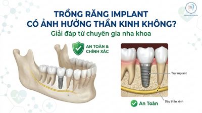 Trồng Răng Implant C&oacute; Ảnh Hưởng Thần Kinh Kh&ocirc;ng? Những Điều Cần Biết