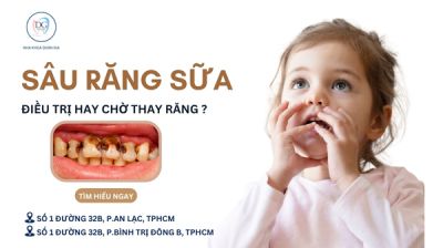 BÉ BỊ SÂU RĂNG SỮA – CÓ CẦN ĐIỀU TRỊ KHÔNG HAY CHỜ THAY RĂNG?
