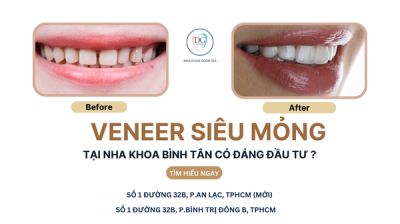 REVIEW VENEER SỨ SIÊU MỎNG TẠI NHA KHOA BÌNH TÂN – CÓ ĐÁNG ĐẦU TƯ?