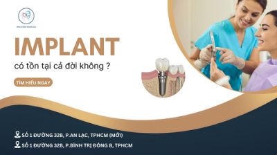 L&Agrave;M RĂNG IMPLANT C&Oacute; L&Agrave;M THAY ĐỔI GIỌNG N&Oacute;I KH&Ocirc;NG?
