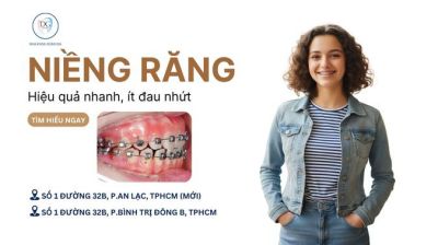 NIỀNG RĂNG MẮC CÀI CÁNH CAM – HIỆU QUẢ NHANH, ÍT ĐAU NHỨC