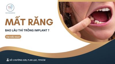 Mất răng bao lâu thì trồng Implant?