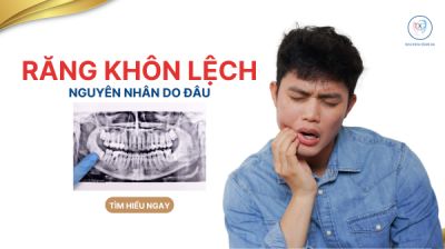 V&Igrave; SAO RĂNG KH&Ocirc;N DỄ MỌC LỆCH? NGUY&Ecirc;N NH&Acirc;N V&Agrave; HƯỚNG XỬ L&Yacute;
