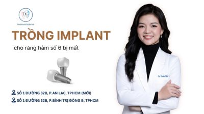 CÓ NÊN TRỒNG IMPLANT CHO RĂNG HÀM SỐ 6 BỊ MẤT?