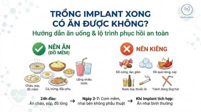 Trồng Implant Xong C&oacute; Ăn Được Kh&ocirc;ng? N&ecirc;n Ăn G&igrave;, Ki&ecirc;ng G&igrave;?