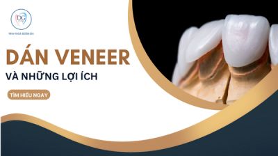 DÁN VENEER VÀ NHỮNG LỢI ÍCH CẦN BIẾT