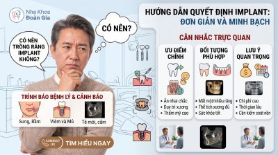 C&oacute; N&ecirc;n Trồng Răng Implant Kh&ocirc;ng? Ưu Điểm, Nhược Điểm V&agrave; Những Điều Cần Biết