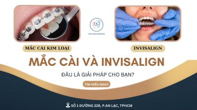 NIỀNG RĂNG MẮC CÀI HAY KHAY TRONG SUỐT?