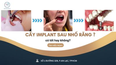 CẤY IMPLANT NGAY SAU KHI NHỔ RĂNG – CÓ TỐT KHÔNG ?