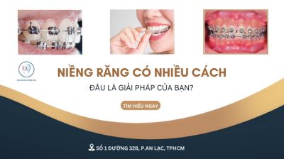 NIỀNG RĂNG CÓ LÂU KHÔNG? RÚT NGẮN THỜI GIAN ĐƯỢC HAY KHÔNG?