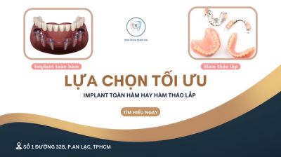 IMPLANT TOÀN HÀM KHÁC GÌ RĂNG GIẢ THÁO LẮP