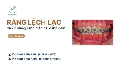NIỀNG MẮC CÀI CÁNH CAM – GIẢI PHÁP HOÀN HẢO CHO RĂNG LỆCH LẠC