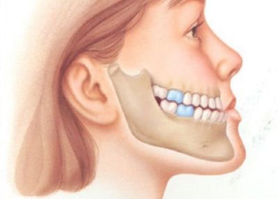 Răng bị hô hàm có niềng răng được không? Giá bao nhiêu?