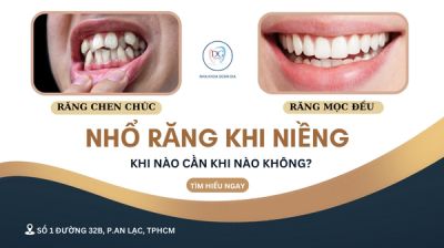 NIỀNG RĂNG CÓ PHẢI NHỔ RĂNG?