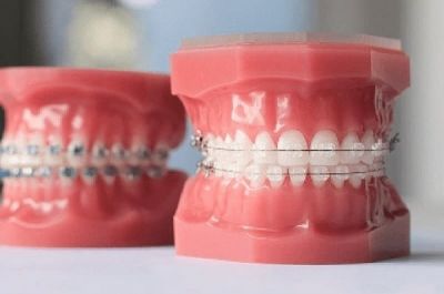 Niềng răng mắc cài trong suốt giá bao nhiêu? Có nên sử dụng?