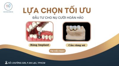 Lựa chọn n&agrave;o tối ưu: Trồng răng Implant hay cầu răng sứ?