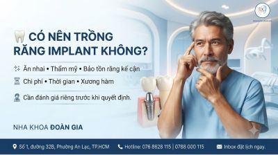 C&oacute; N&ecirc;n Trồng Răng Implant Kh&ocirc;ng? Ưu Điểm, Nhược Điểm V&agrave; Những Điều Cần Biết