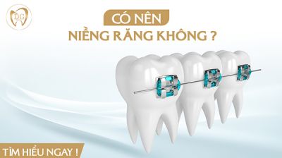 Có nên niềng răng không? Lợi ích và tác hại của niềng răng là gì?